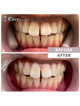 イージーホワイトニング 中野店(easy whitening)/セルフホワイトニング症例写真