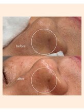 レア(Lea)/しっかり浮かせて毛穴洗浄＊