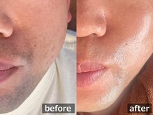 ルナステラ 七尾店/LEDローズ脱毛