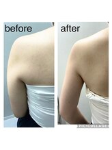 エンチャント(ENCHANT)/脇のハミ肉超音波リフト