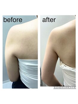 エンチャント(ENCHANT)/脇のハミ肉超音波リフト