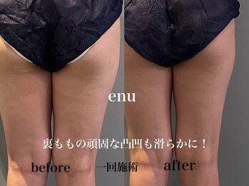 エヌ 白金台(enu)/セル脂肪に効果的