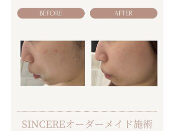シンシア(SINCERE)/オーダーメイド肌改善プログラム