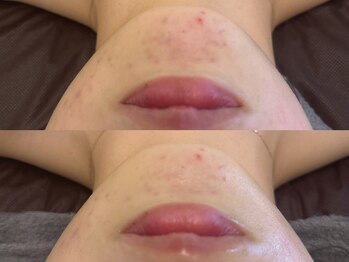 モナートドゥ(Monartdeux)/ニキビ・赤みの改善