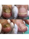 ◆変形爪の再生補正