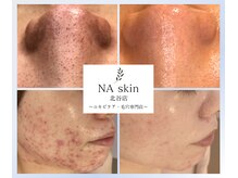 エヌエースキン 北谷店(NAskin)の雰囲気（ハーブピーリング/ニキビケア/毛穴ケア/沖縄北谷/エステ/美肌）