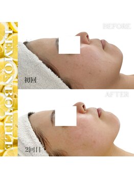 リアム(LiAm)/脂肪分解剤《レモンボトル》