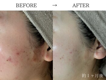 コム(comme39)/当店人気NO.1★赤み・ニキビケア