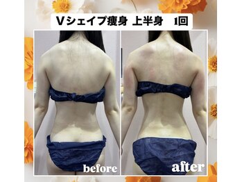 ルピナス ヒサヤ(LUPINUS hisaya)/Vシェイプ痩身