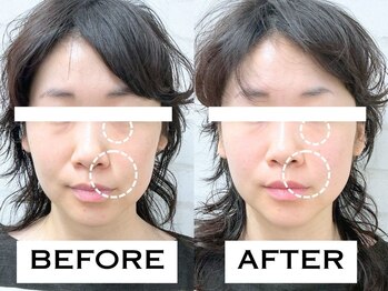 ビハリスト 秋葉原電気街口店/ 目のクマとほうれい線が改善！