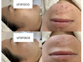 ウララカ(uraraca)/大人ニキビ諦めないで!