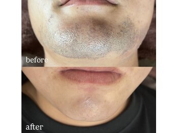 イルナ(ILUNA)/顔脱毛♪清潔感UP↑