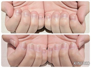 ネイルサロン きのこの写真/深爪/爪が薄い/小さい/モチが悪い…お悩み爪様必見!凄腕スタッフがオーダー施術◎思わず見惚れる指先に♪