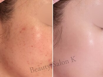 ケイ(K)/《頬のニキビ》肌質改善コース