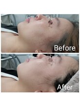 レン(Ren)/光フェイシャル〈小顔/たるみ〉