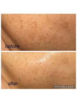 エスカル ボーテ(escale beaute)/シミケア・しわ・たるみ