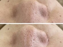 ヴィーヴ 京橋(vive)/【韓国式3D毛穴洗浄】