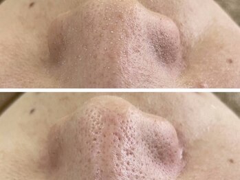 ヴィーヴ 京橋(vive)/【韓国式3D毛穴洗浄】