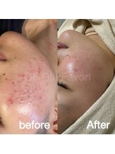 オフオルファヴォリ(OF Olu:Favori)/before after