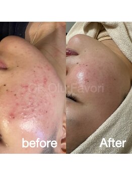 オフオルファヴォリ(OF Olu:Favori)/before after