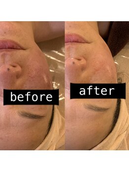 エマーチェ 自由が丘(emmace)/赤み(炎症肌さん)before→after