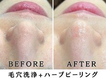レヴィア(Revia)の雰囲気（毛穴洗浄/美白/ニキビケア/毛穴/六本木/ハーブピーリング/小顔）