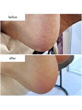 ケアプラス(care plus)/足裏角質ケア