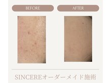 シンシア(SINCERE)/オーダーメイド肌改善プログラム