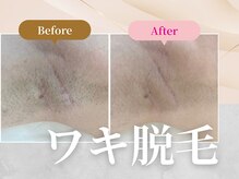 フェルナ(FERNA)の雰囲気（ワキ脱毛BeforeAfter☆）