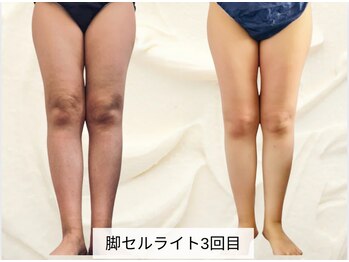 トレゾール(tresor)/【痩身】セルライト撃退