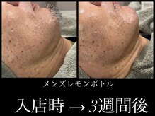 ビーエルティー(blt)/メンズレモンボトル