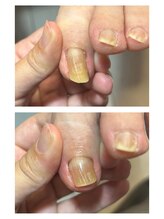 究極のワンカラー専門店/巻き爪ケア