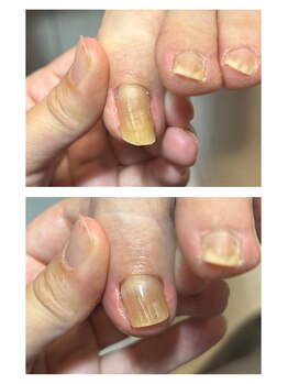 究極のワンカラー専門店/巻き爪ケア