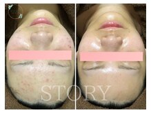 繰り返すニキビケア・毛穴もハーブピーリングで改善◎艶肌へ◎