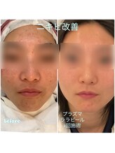 プレヴェール 神戸三宮/プラズマミスト＋ララピール