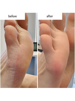 ケアプラス(care plus)/足裏角質ケア