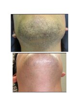 エム(M)/ひげ脱毛