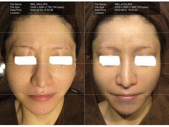 ブリエールラミール/毛穴、たるみケア