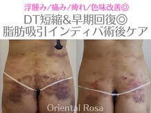 オリエンタルローザ 表参道(Oriental Rosa)/お腹脂肪インディバアフターケア