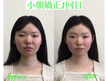 オズ六本木/小顔矯正モニター様1回目施術