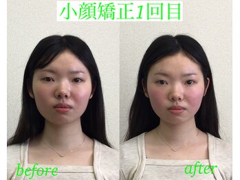 オズ六本木/小顔矯正モニター様1回目施術