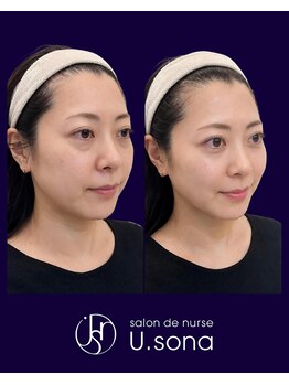 小顔・脂肪コントロール専門 salon de nurse U.sona～松本店～/【顔造形】30代脂肪分解増殖症例