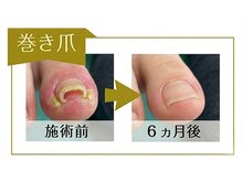 リフト 有楽町店(Re:ft)の雰囲気（痛みが少ない　切らない　特殊なプレートを使用した巻き爪補正）