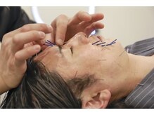 ウーシアサロン(OUSIA SALON)/男性の美容鍼増えてます[メンズ]