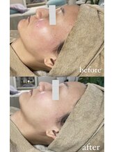 ミーミドットアイ(Mi-mi.i)/WAX後は絶対炭酸ガスパック！