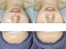 エモーショナル 姫路(Emotional)/ララピール×LDM【毛穴/艶肌】