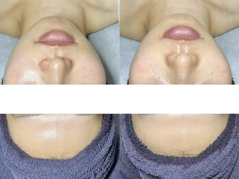 エモーショナル 姫路(Emotional)/ララピール×LDM【毛穴/艶肌】