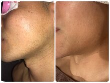 ノノケケ(NONOKEKE)/【メンズ脱毛】　ヒゲ脱毛