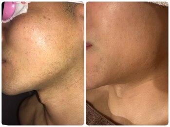 ノノケケ(NONOKEKE)/【メンズ脱毛】　ヒゲ脱毛