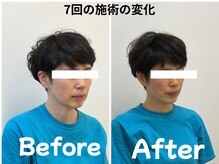 ゆず鍼灸整骨院/7回で見た目年齢-5歳 美容鍼整体